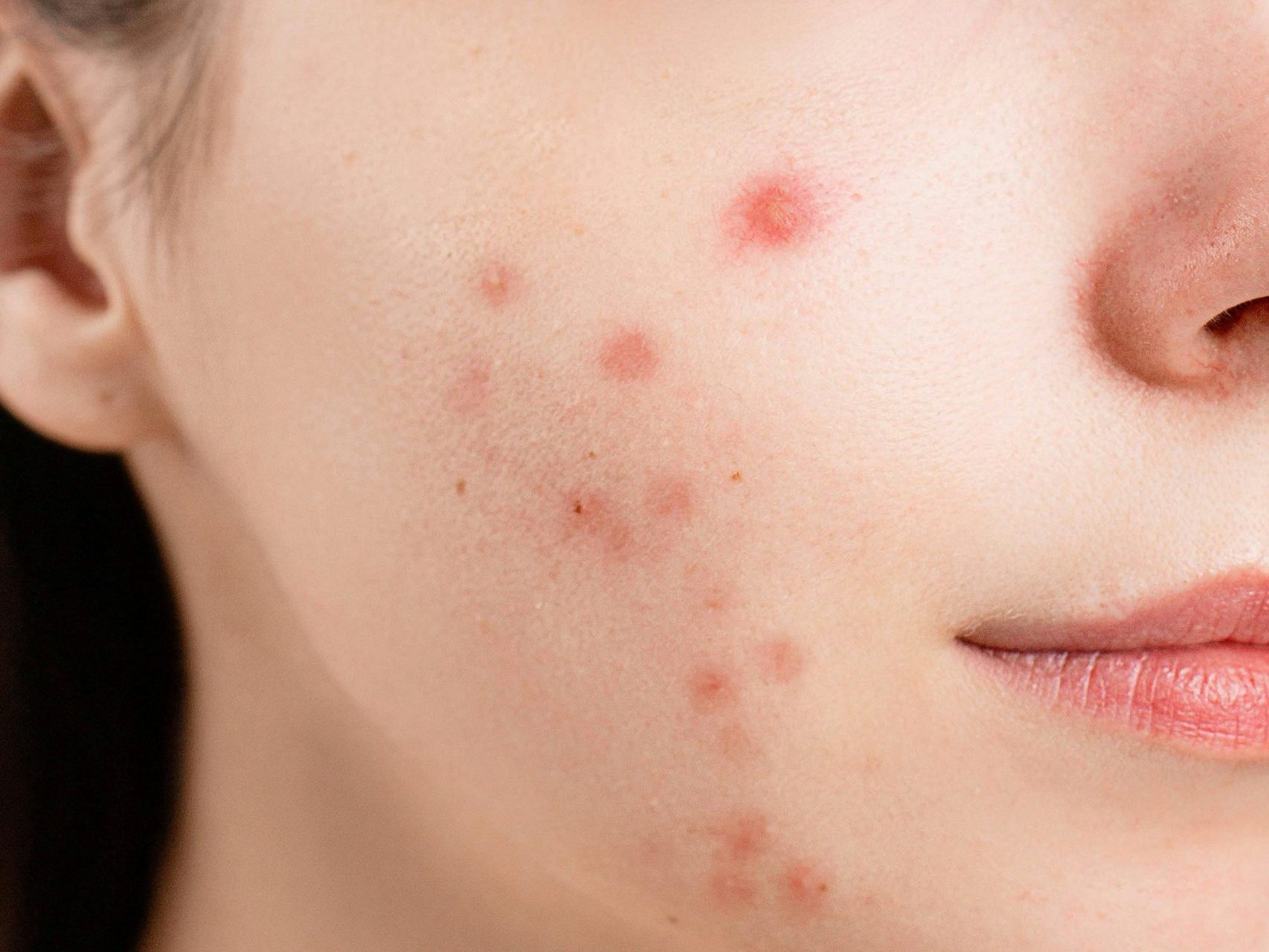 You are currently viewing Jakie infekcje wywołuje gronkowiec?